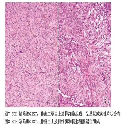 新近认识的胃肠道间叶性肿瘤
