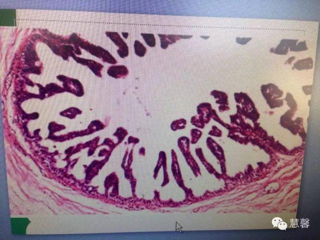 低级别DCIS？（李晟磊分享，孔祥田等讨论）