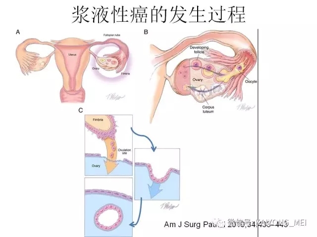 卵巢癌的病理诊断新进展（一）