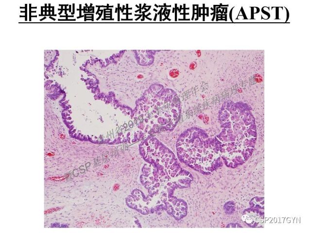 中华病理学会基层培训遵义站讲座（一）——卵巢和输卵管浆液性肿瘤的诊断和鉴别诊断