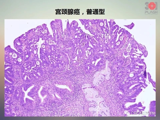 宫颈腺癌的临床病理研究进展