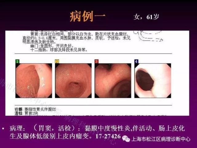 上消化道低级别上皮内瘤变的那些事