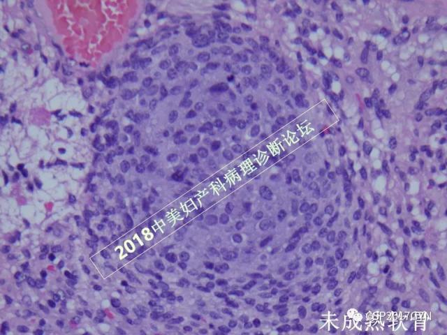 卵巢畸胎瘤诊断难点