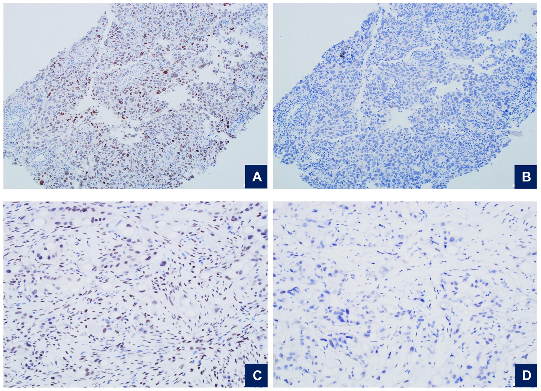 常学常新-转移性乳腺癌诊断中的免疫组化（二）
