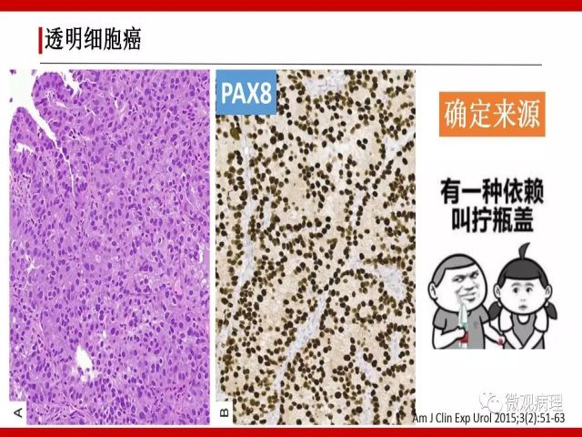 泌尿课程/尿路腺样病变的诊断要点