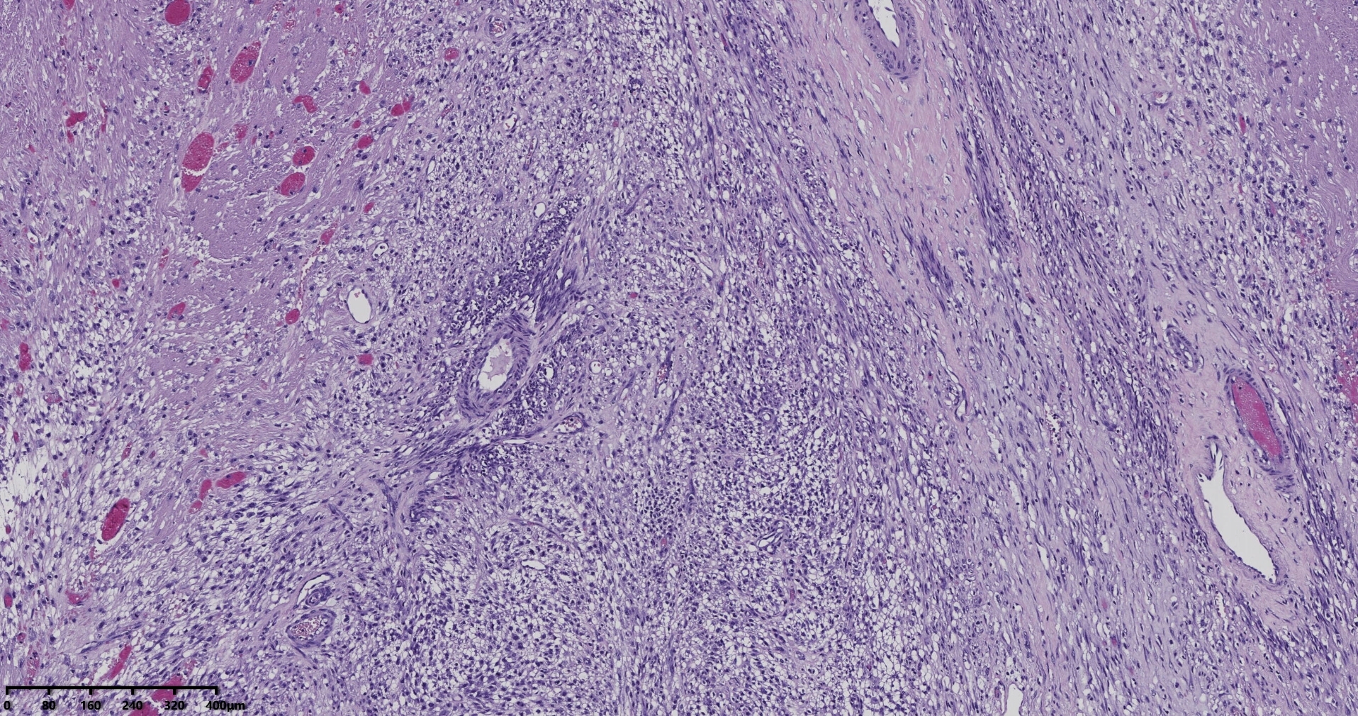 子宫多发性平滑肌瘤伴肉瘤