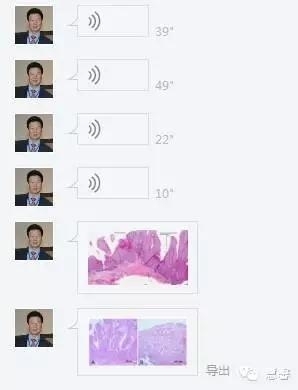 阴道鳞状上皮乳头状瘤？尖锐湿疣？（孔祥田老师病例分享，粉蓝医疗科技（杭州）有限公司女性生殖2群讨论，孔祥田(Max)*Roswell*老师讲解）