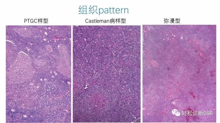 血管免疫母T细胞淋巴瘤