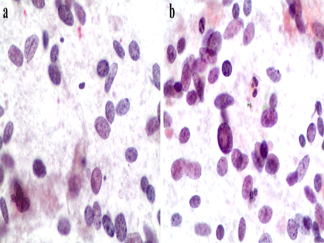 甲状腺透明梁状肿瘤概述 甲状腺透明梁状肿瘤概述