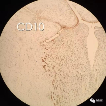 High grade nested variant Urothelial carcinoma(老胡分享，孔祥田老师讲解)