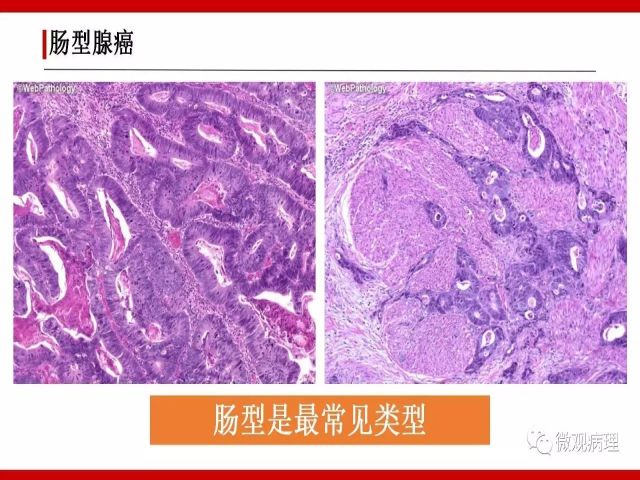 泌尿课程/尿路腺样病变的诊断要点