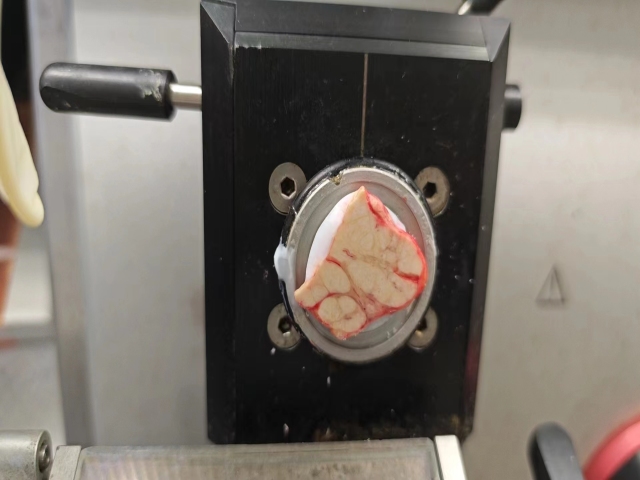 涎腺IG4炎症