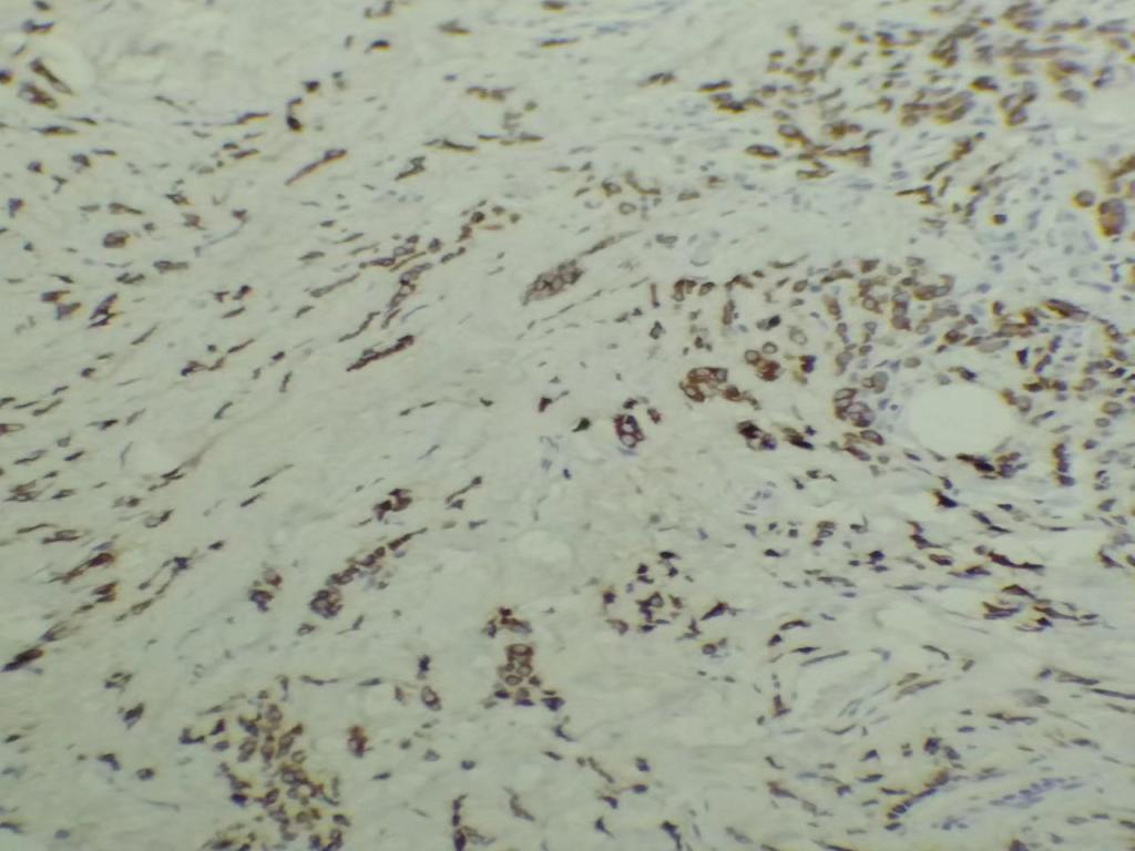 组织学1级的乳腺浸润性导管癌（札记七十五）