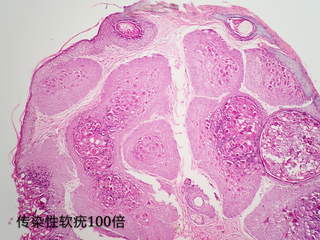 病理科工作札记（三十七）传染性软疣