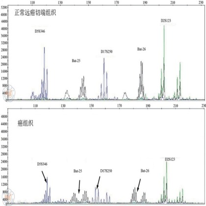如何根据组化结果判读 dMMR 和 pMMR？方法原来如此简单