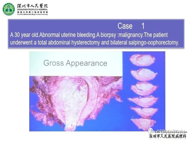 2019USCAP妇科病理热点介绍