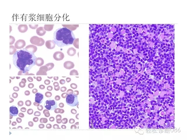 慢性淋巴细胞性白血病