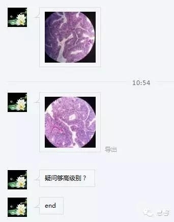 结、直肠管绒毛状腺瘤-高级别病变取材、诊断及报告相关问题（悄悄分享、掌心及孔祥田(Max)*Roswell*NM老师讲解）