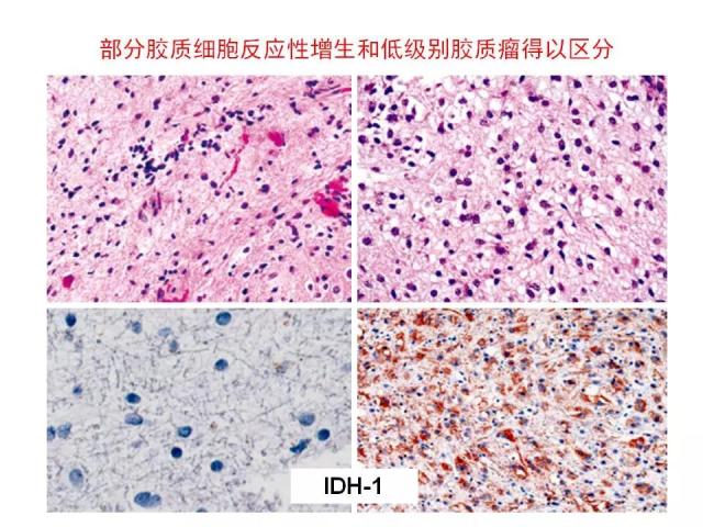 [病理诊断]广东省人民医院李智：胶质瘤的病理诊断 从组织学表型到分子表型