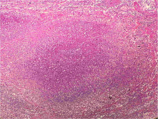 类似粟粒性结核的类鼻疽一例