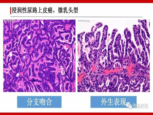 泌尿课程/浸润性尿路上皮癌病理学类型