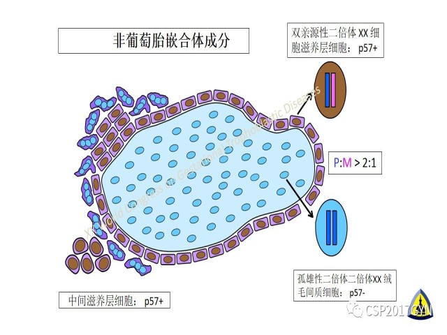 p57免疫组化染色及基因分型 在葡萄胎精确诊断中的应用