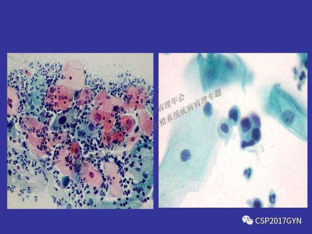 中华病理学会基层培训遵义站讲座（二）——宫颈细胞学诊断中陷阱与筛查进展