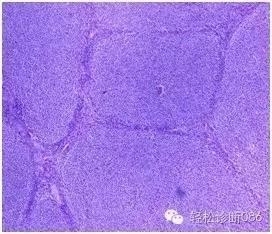 小B细胞NHL——FL（1）