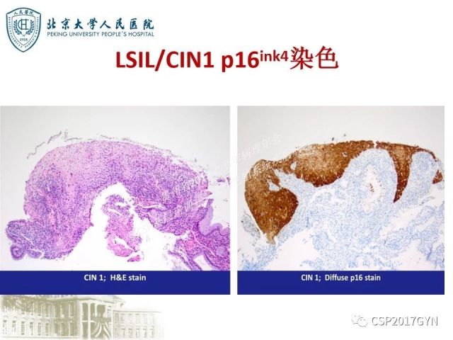 中华病理学会基层培训遵义站讲座（三）——宫颈鳞状上皮病变的病理诊断与鉴别诊断