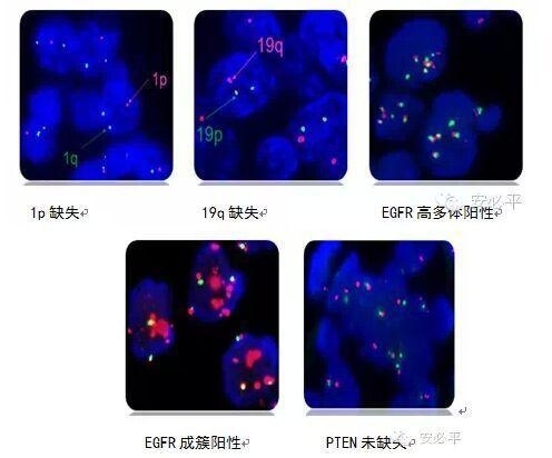 FISH在胶质瘤中的应用