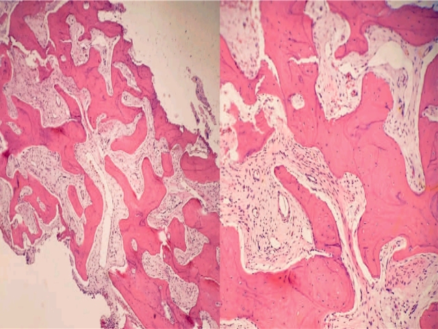 家族性腺瘤性息肉病综合征之庖丁解牛（三）