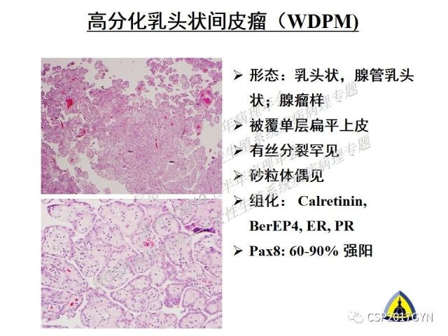 中华病理学会基层培训遵义站讲座（一）——卵巢和输卵管浆液性肿瘤的诊断和鉴别诊断