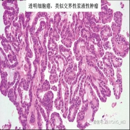 卵巢癌的病理诊断新进展（三）