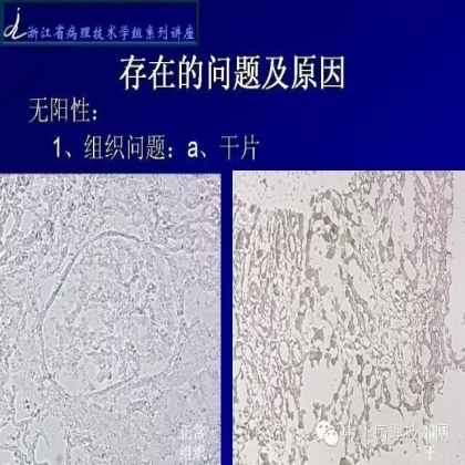 探讨免疫组织学在肾穿标本中的应用
