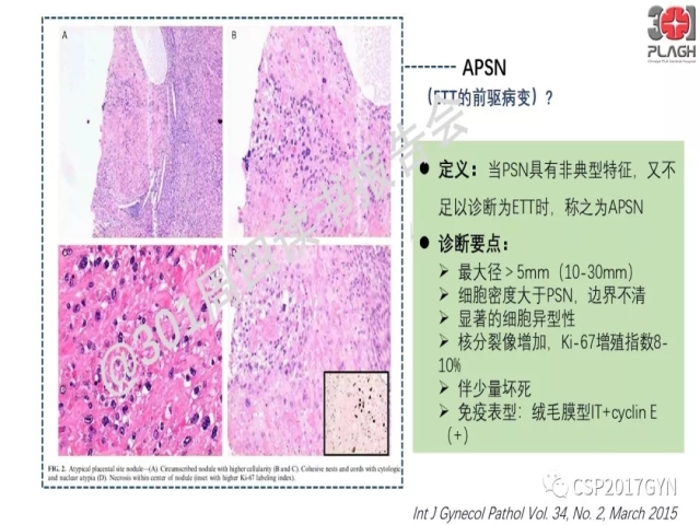中间型滋养细胞肿瘤的诊断及鉴别诊断