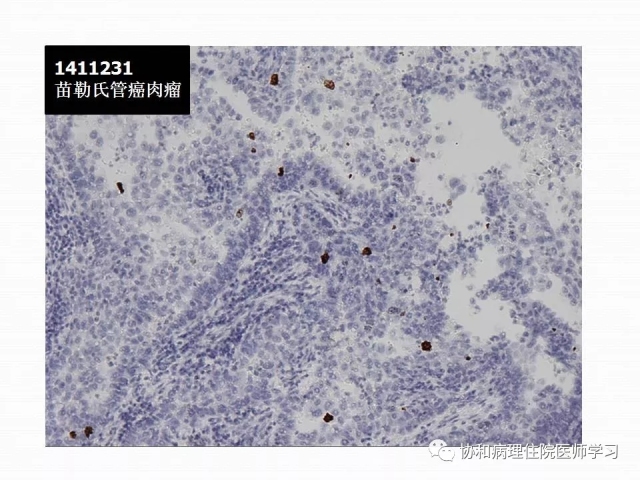 病理学基础知识 : 核分裂像的识别
