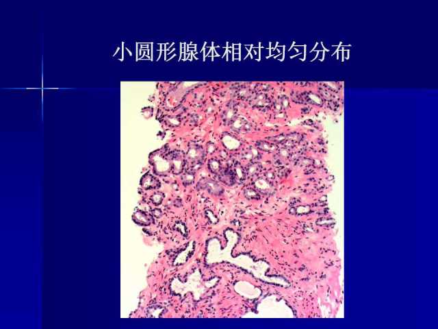 前列腺病理诊断线索（上）——黄教悌