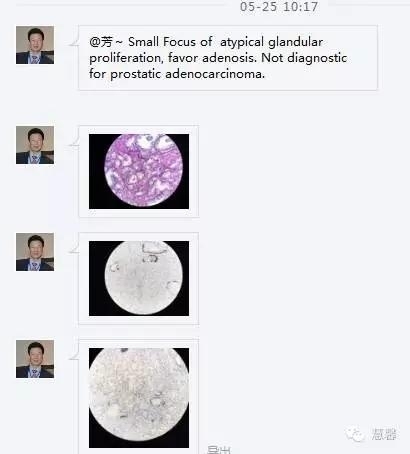 前列腺腺癌？（芳分享病例，华夏泌尿群讨论，孔祥田老师讲解）