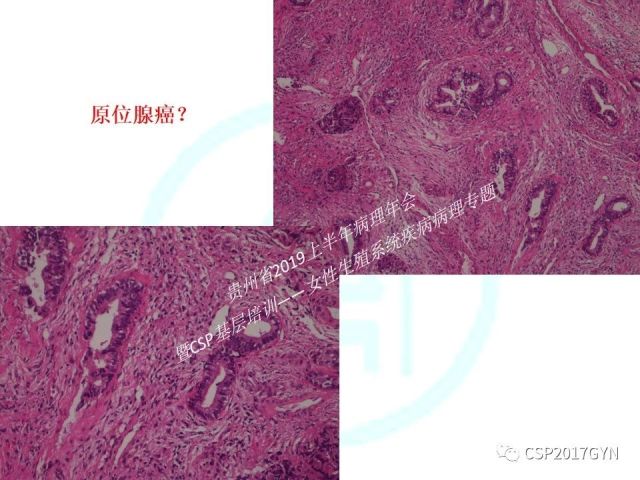 中华病理学会基层培训遵义站讲座（四）——宫颈腺癌的诊断及新分型