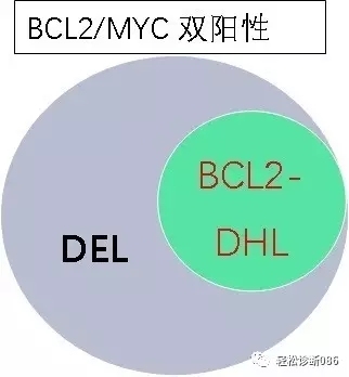 侵袭性B细胞淋巴瘤——GZL（3）