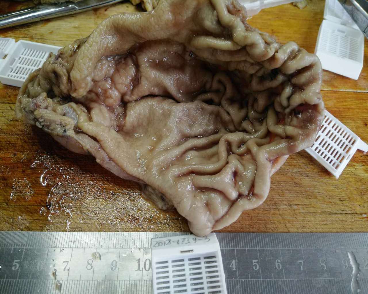 病理科工作札记（二十二）胃印戒细胞癌经典病例