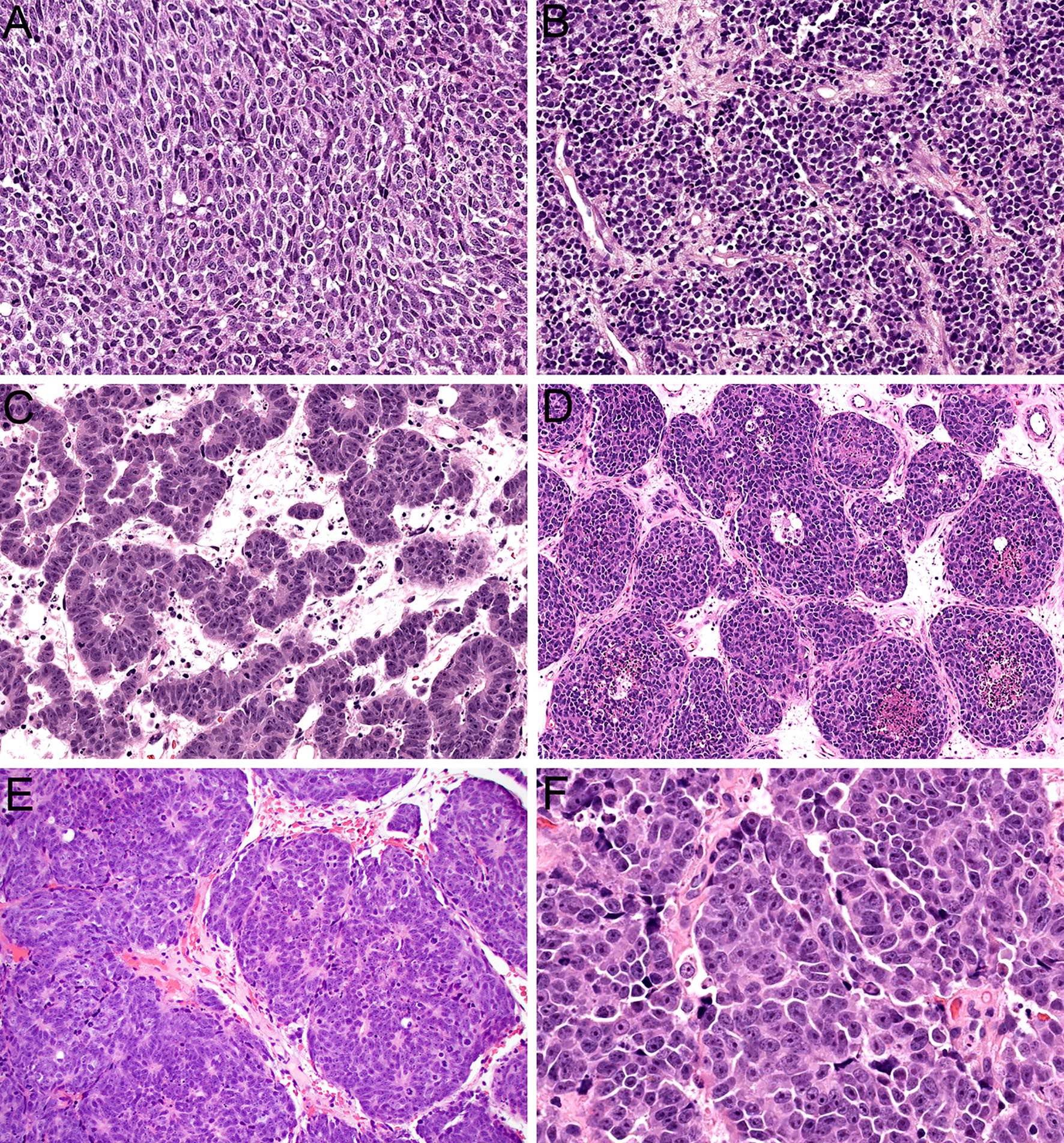 鼻腔鼻窦高级别神经内分泌与神经外胚层肿瘤新进展解读（四）