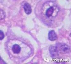 霍奇金淋巴瘤(2)
