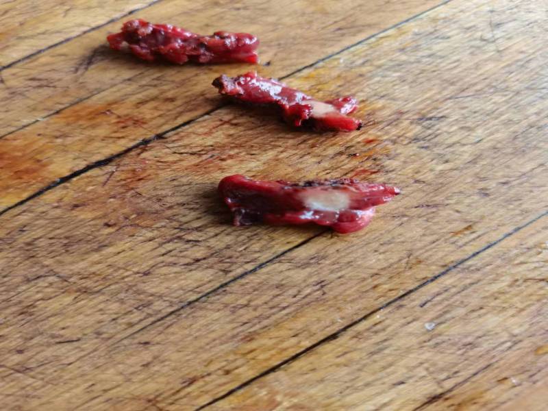甲状腺乳头状癌滤泡亚型（札记七十八）