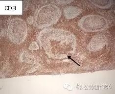 小B细胞NHL——FL（1）