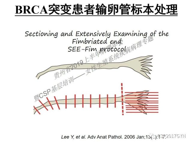 中华病理学会基层培训遵义站讲座（一）——卵巢和输卵管浆液性肿瘤的诊断和鉴别诊断