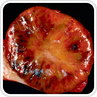 Webpathology.com-镜像翻译（自学使用，版权归原网站所有）