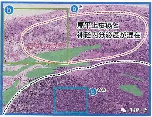 病理解读：神经内分泌癌伴扁平上皮癌