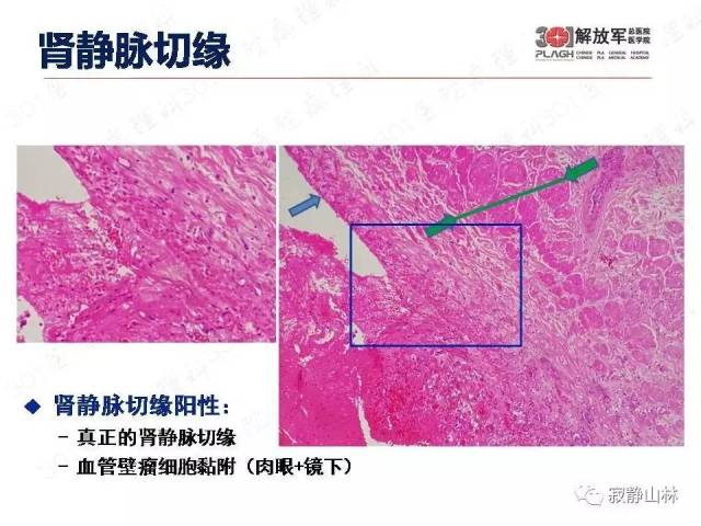 泌尿系统常见肿瘤标本病理报告规范