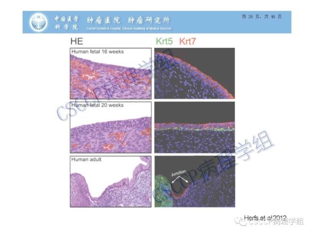 宫颈癌前病变中的诊断难点及阴道镜中ECC的 应用价值